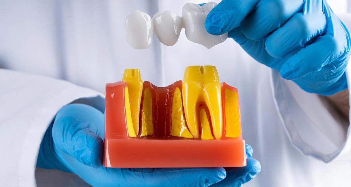 https://trusmiledental.co.uk/wp-content/uploads/3-tooth-bridge-cost-uk-1200x640.jpg