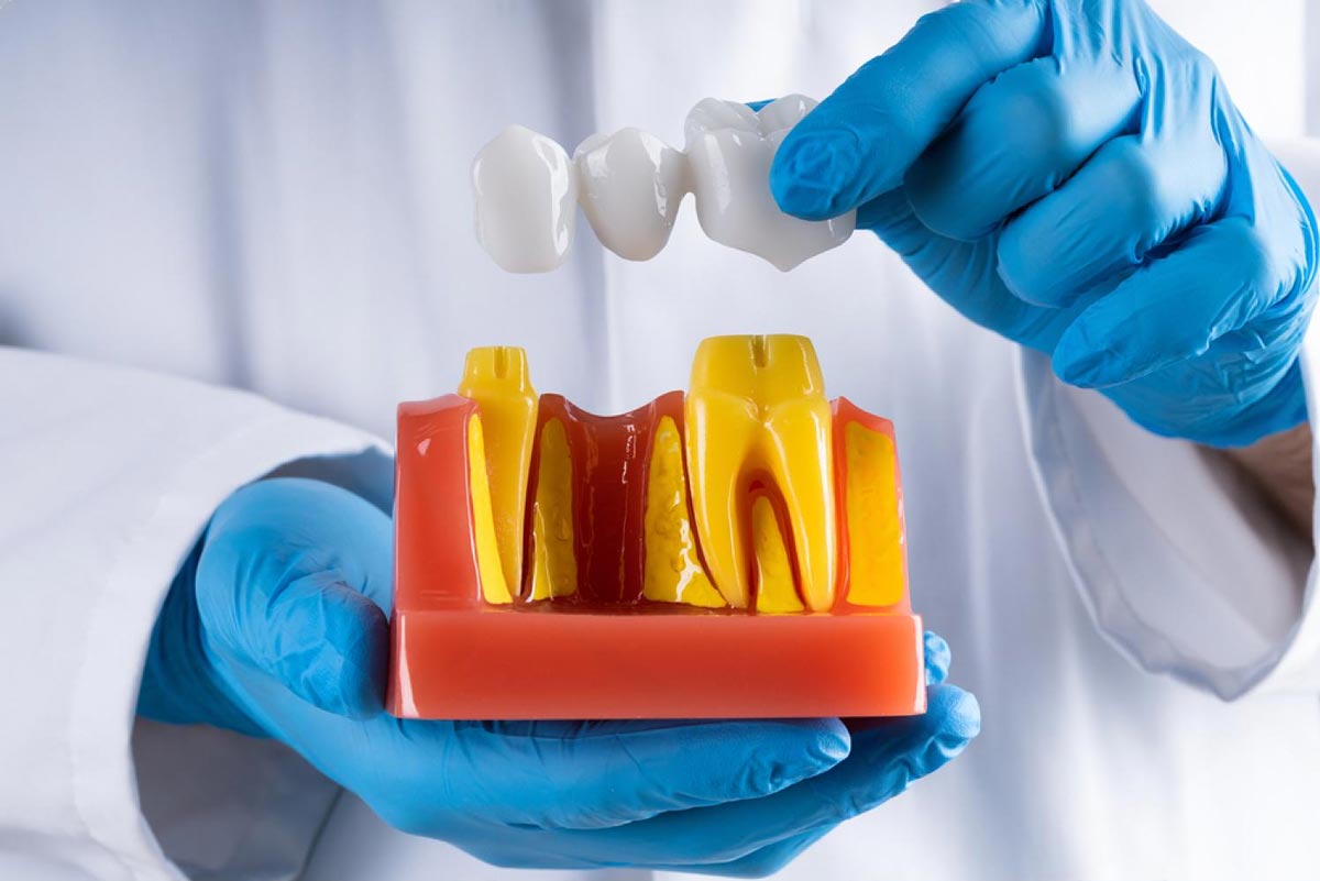 https://trusmiledental.co.uk/wp-content/uploads/3-tooth-bridge-cost-uk.jpg