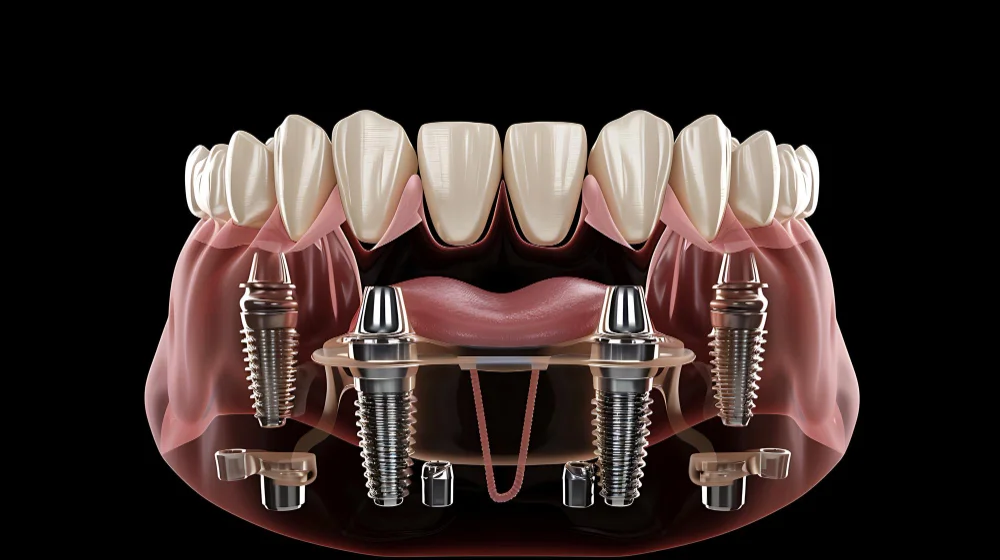 All On 4 Implants Example