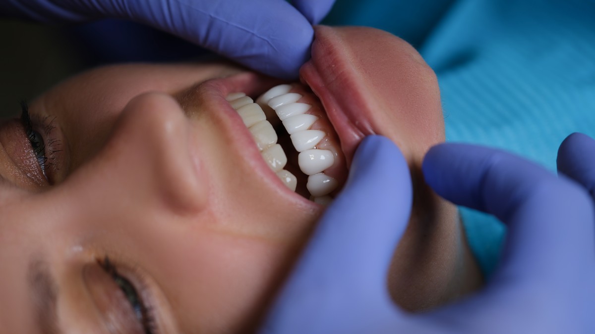 https://trusmiledental.co.uk/wp-content/uploads/Composite-Bonding-vs-Veneers-Comparison.jpg