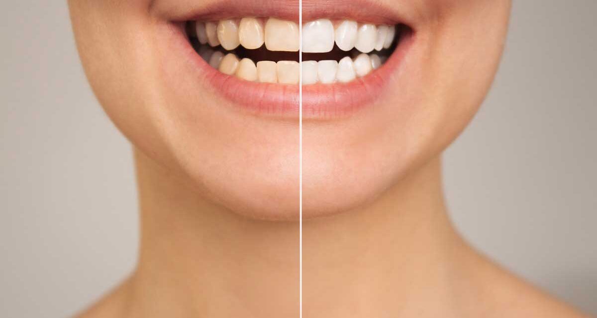 https://trusmiledental.co.uk/wp-content/uploads/Enlighten-Teeth-Whitening-1-1200x640.jpg