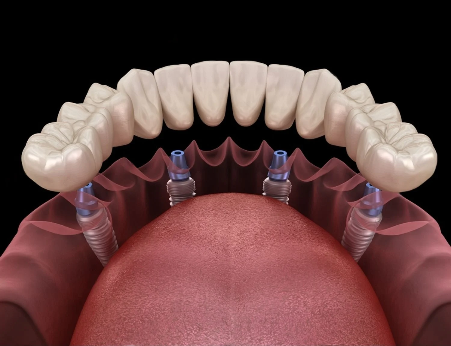 Affordable Denture Implants