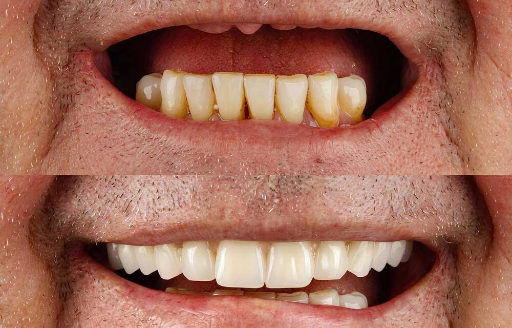 https://trusmiledental.co.uk/wp-content/uploads/all-on-4-dental-implants-uk-cost-1000x640.jpg