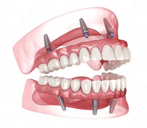All On 4 Implant Dentures Example