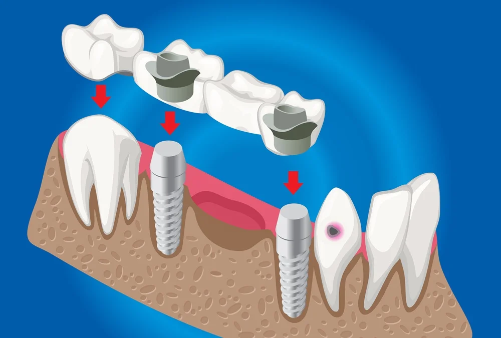 Dental Bridge Vs Implants Cost