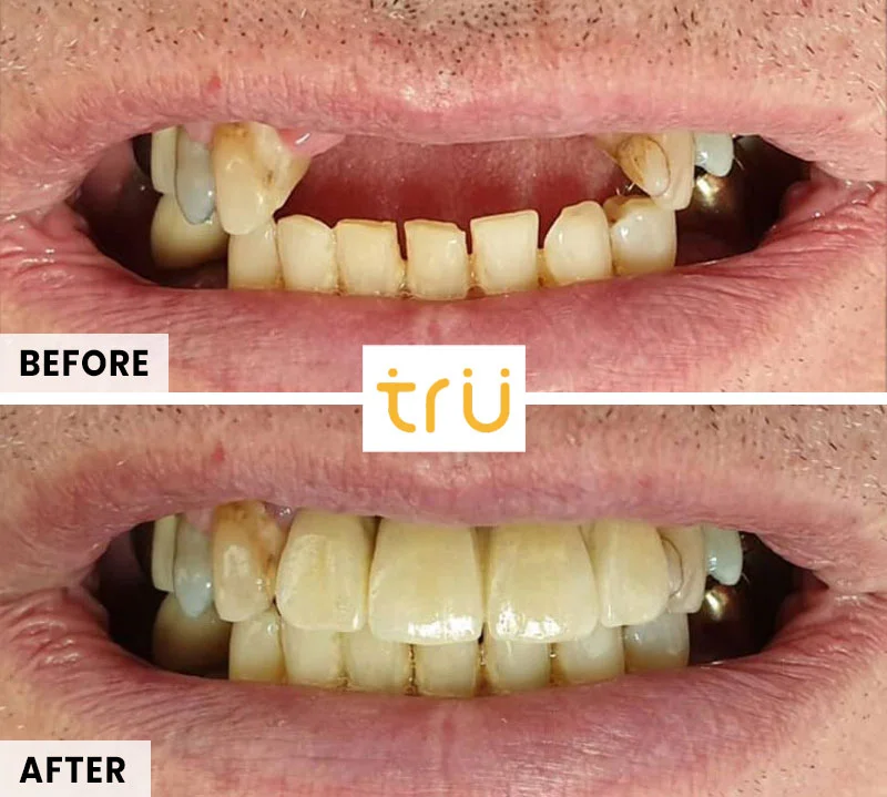 Dental Implants Before After 2