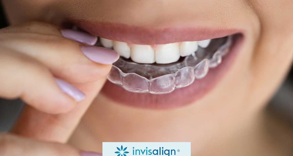https://trusmiledental.co.uk/wp-content/uploads/how-does-invisalign-work-1200x640.jpg