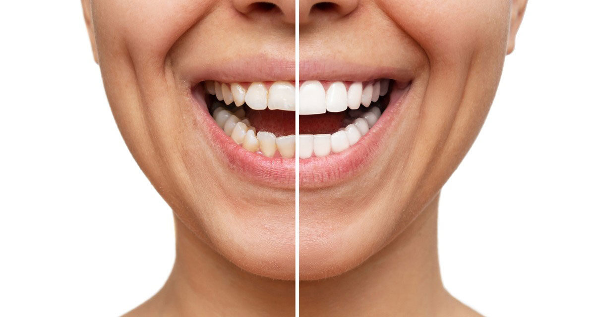 https://trusmiledental.co.uk/wp-content/uploads/how-much-are-porcelain-veneers-1200x640.jpg