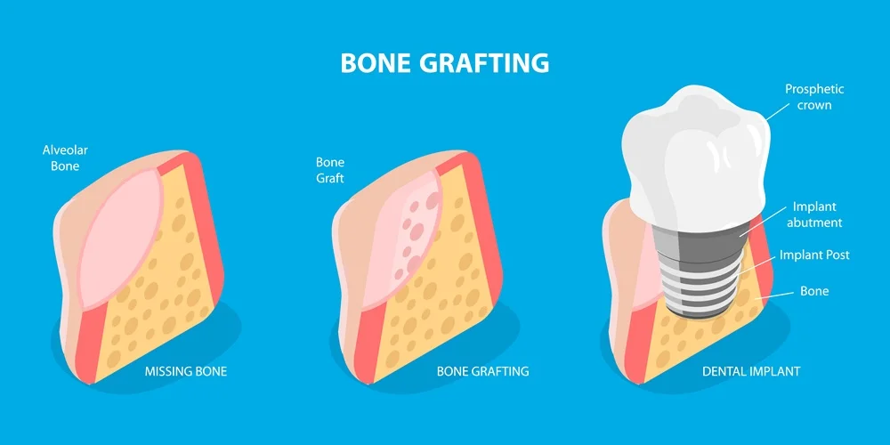Implant Dentures Bone Grafting