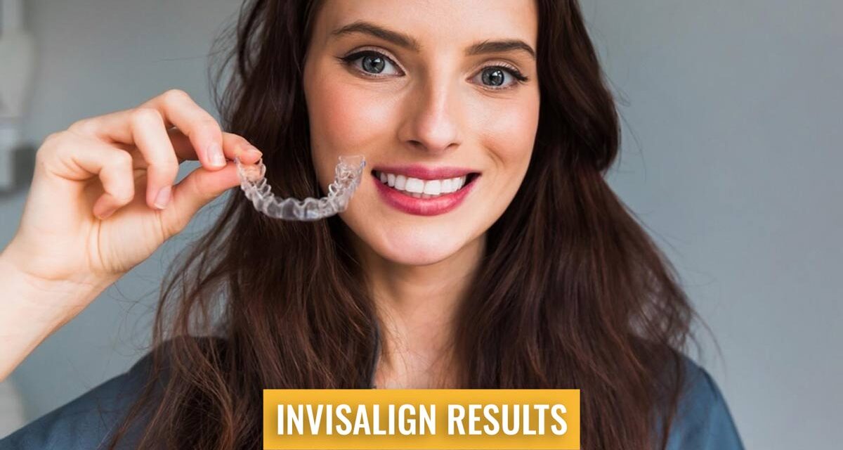 https://trusmiledental.co.uk/wp-content/uploads/invisalign-before-and-after-worst-cases-results-1200x640.jpg