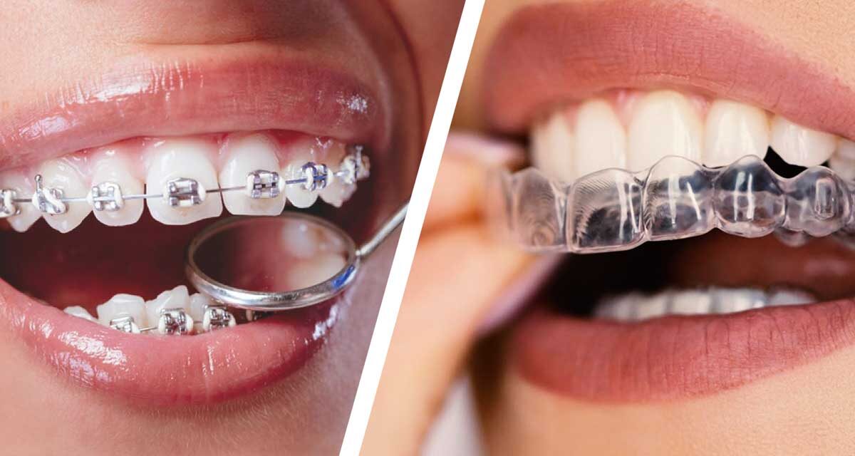 https://trusmiledental.co.uk/wp-content/uploads/invisalign-vs-braces-cost-faster-1200x640.jpg