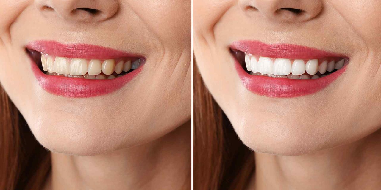 https://trusmiledental.co.uk/wp-content/uploads/post_11-1280x640.jpg